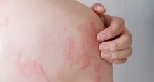 Do your hives keep coming back